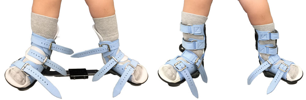 CPro Direct. ADM for Ponseti Night Bracing CPro Direct. ADM for Ponseti Night Bracing